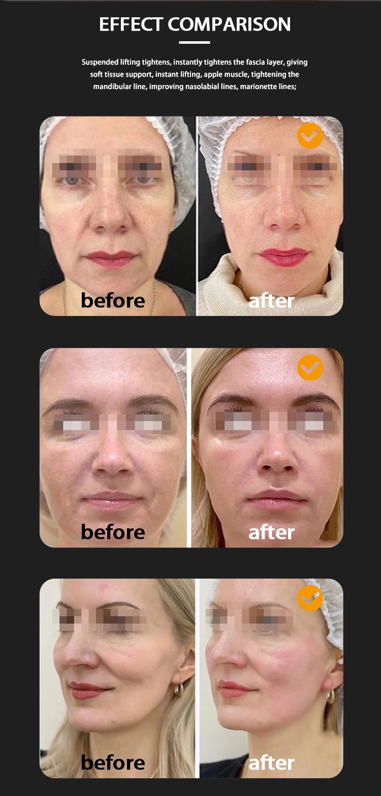 Double handle 7D HIFU Facial Lifting Device With 7 Cartridges