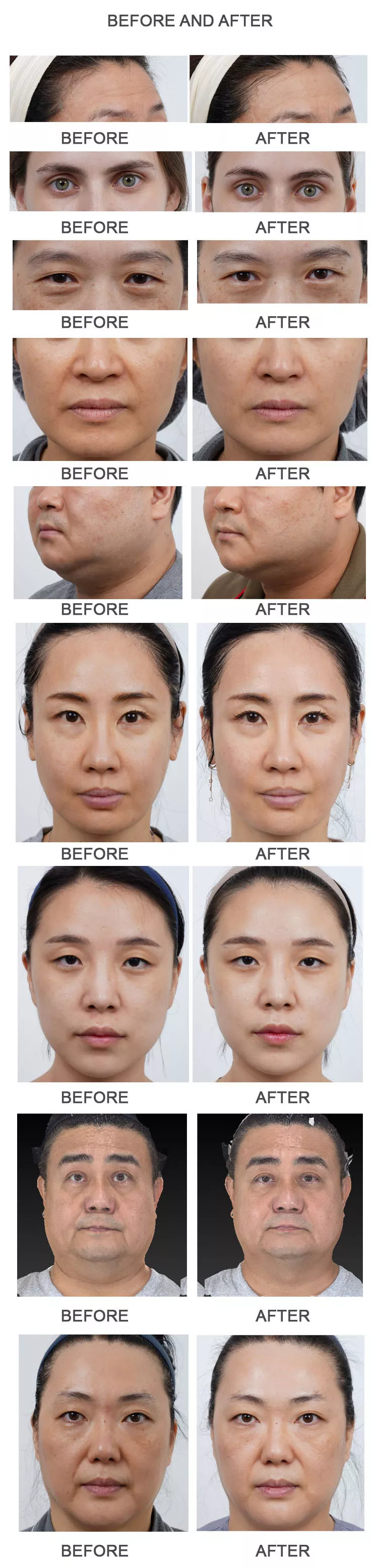 Latest 7D HIFU Ultra Booster pen circular 4 handles Anti-aging Machine
