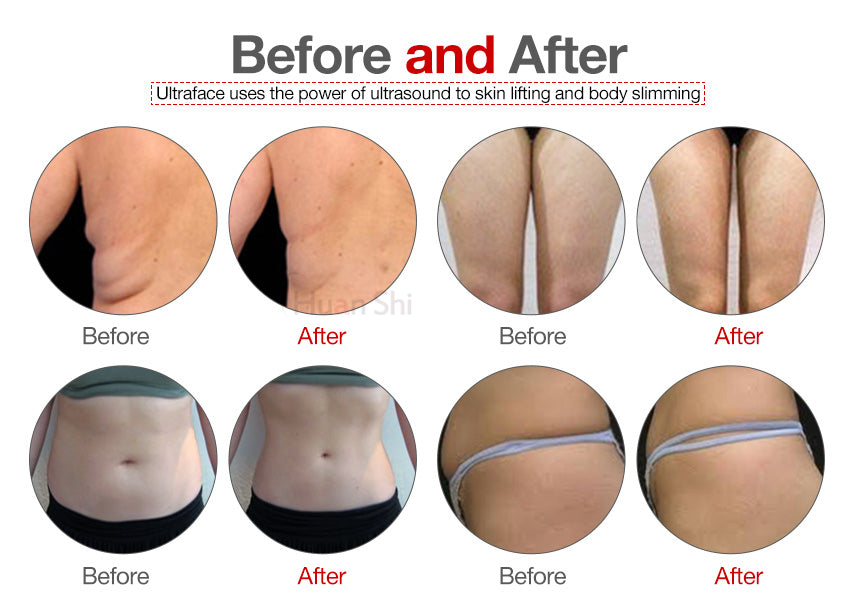 Vertical cryolipolysis 2 handles Weight Loss machine