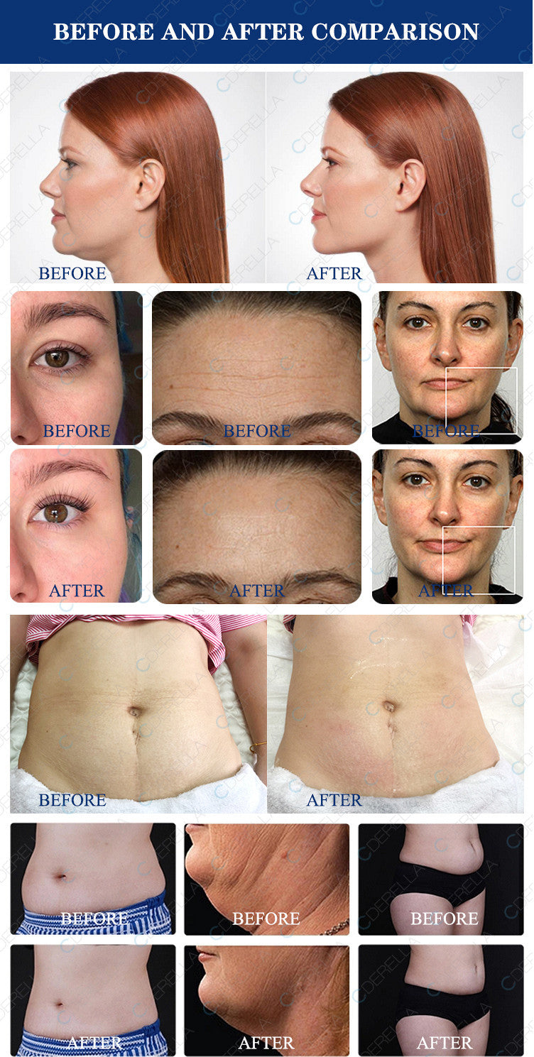40k Cavitation Ultrasound RF lifting Slimming Machine
