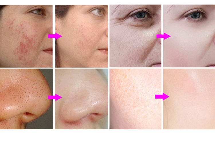 Multifunctional 10 in 1 hydra facial microdermabrasion machine