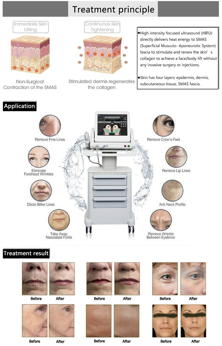 Hifu 2D Anti-wrinkle skin Tightening Face Lifting Device