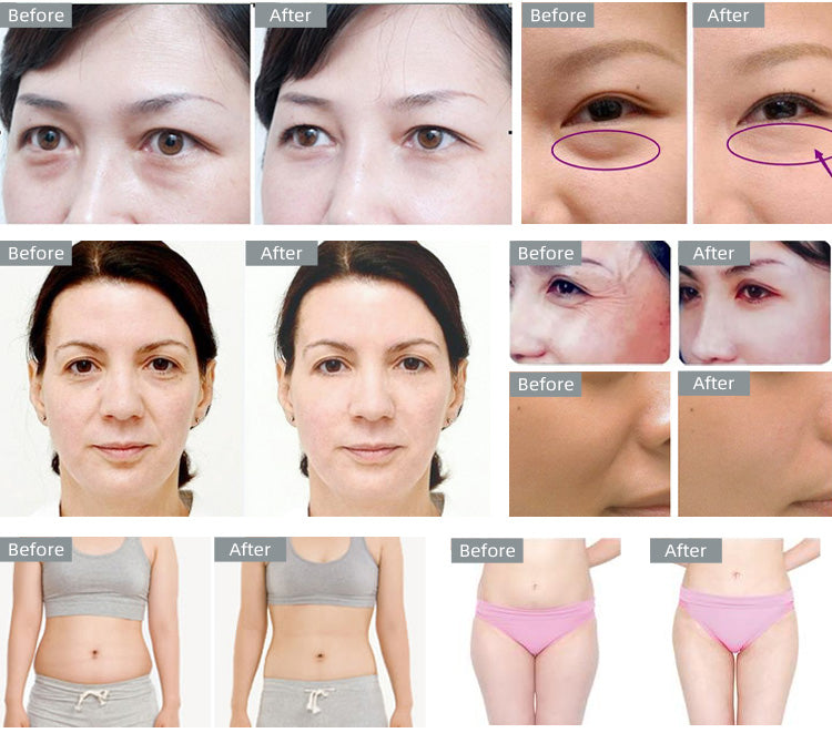 40k Cavitation Ultrasound RF lifting Slimming Machine