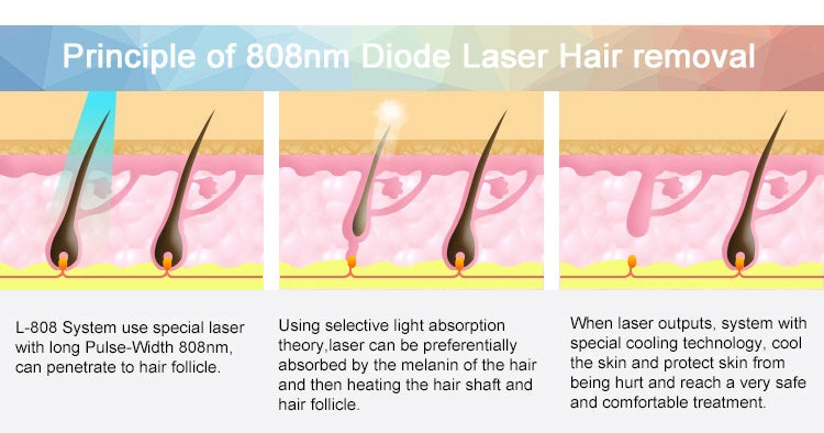 2000W Double Handle Diode Laser Hair Removal Machine
