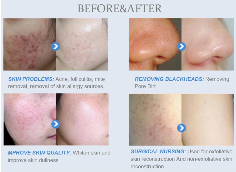 Multifunctional 10 in 1 hydra facial microdermabrasion machine