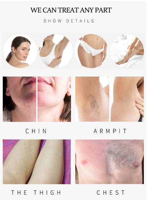 2000W Double Handle Diode Laser Hair Removal Machine