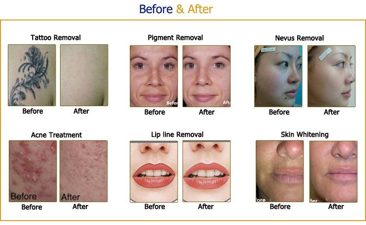 Black Vertical Picosecond Laser Tattoo Removal Pigmentation Therapy Device
