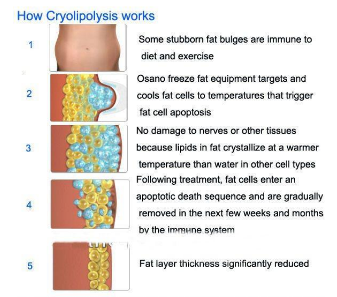 Professional Vertical Cryolipolysis Machine with 4 handles
