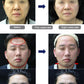2 in 1 7D HIFU Peninsula Ultrasonix Precise Anti-aging  healing head RF Decives