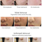 Picosecond Tattoo Removal Pigmentation Carbon Peeling Rejuvenation skin whitening