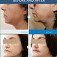 Vertical 7D HIFU Facial Lifting Device With 7 Cartridges