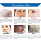 Picosecond Laser Tattoo Removal Device Skin Rejuvenation Pigmentation Therapy