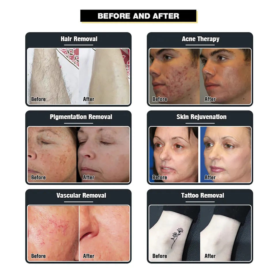 Customizable Oem Odm Non-invasive Hair Removal Salon Use Home Use Permanent Hair Removal 755-808-1064nm