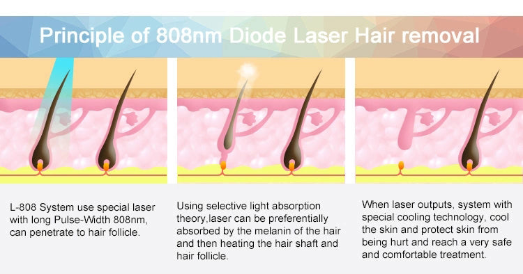 Professional 808nm Black Gold Diode Laser Hair Removal Machine