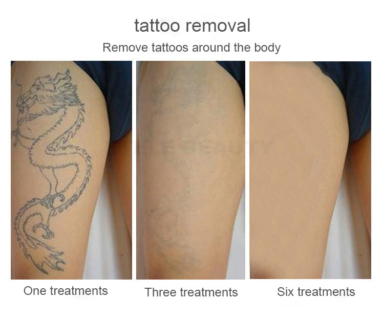 Portable picosecond laser tattoo pigment removal