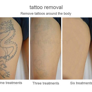 Non-Invasive Picosecond Laser Tattoo Removal  Machine