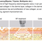 6 in 1 40k cavitation cellulite remover  beauty machine