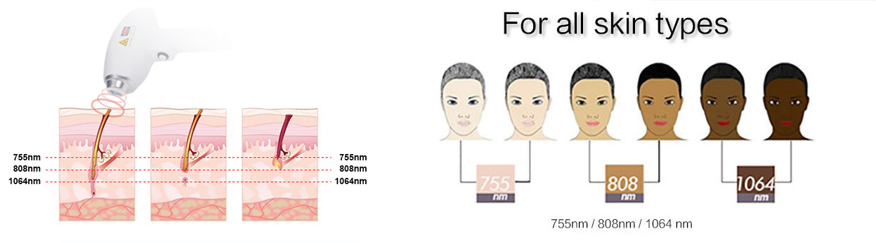 2000w  threewavelength 808nm painless diode laser hair removal machine