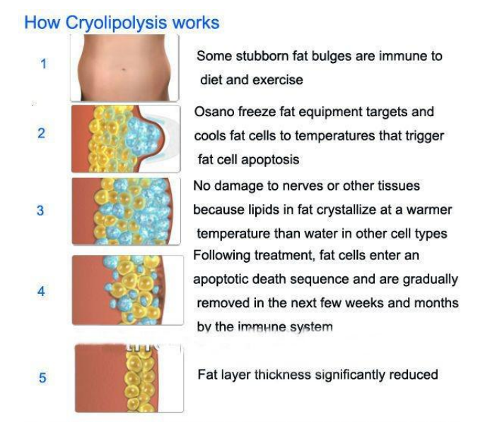 Professional Vertical Cryolipolysis Machine with 4  handles